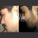 resultados minoxidil 5