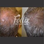 resultados minoxidil 6