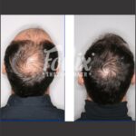 resultados minoxidil 9